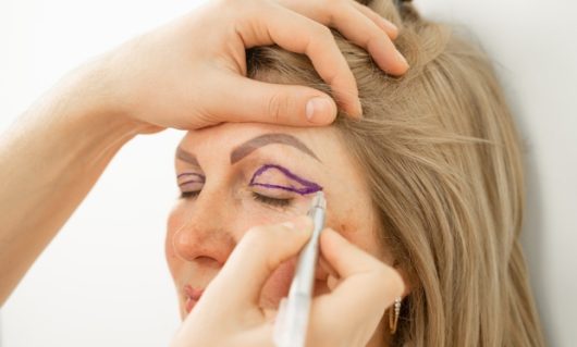 eyelid-surgery-01 eyelid-surgery-01