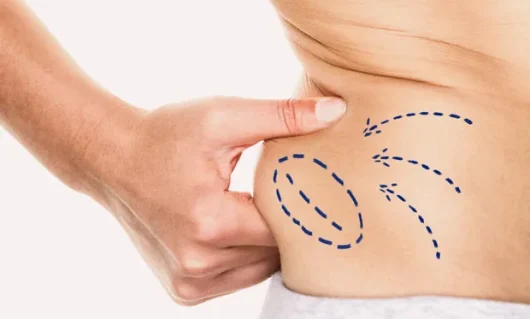 liposuction-01 liposuction-01